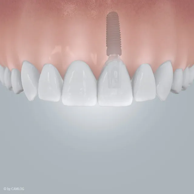 Einzelzahn-Implantat