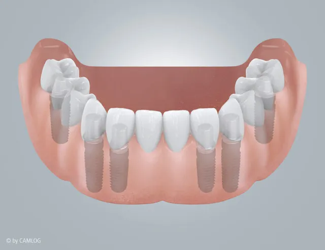 Gesamtsanierung Implantate