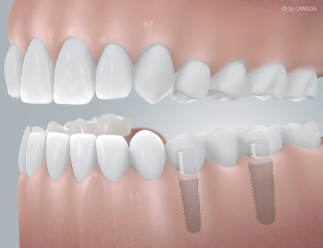 Implantatbr&uuml;cke