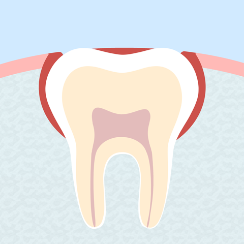 Entz&uuml;ndeter Weisheitszahn