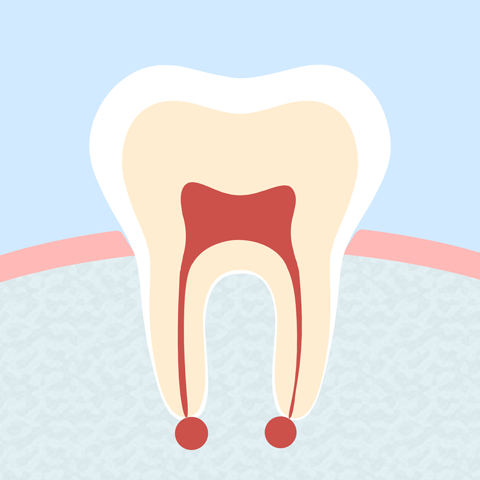 Endodontitis-Therapie bei Zahnnerventzündung